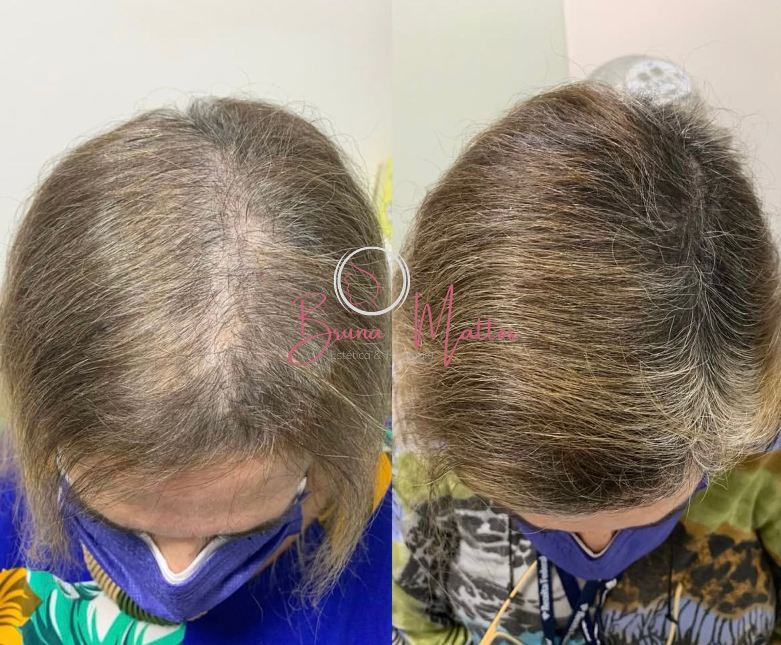Antes e depois do tratamento capilar — paciente 2