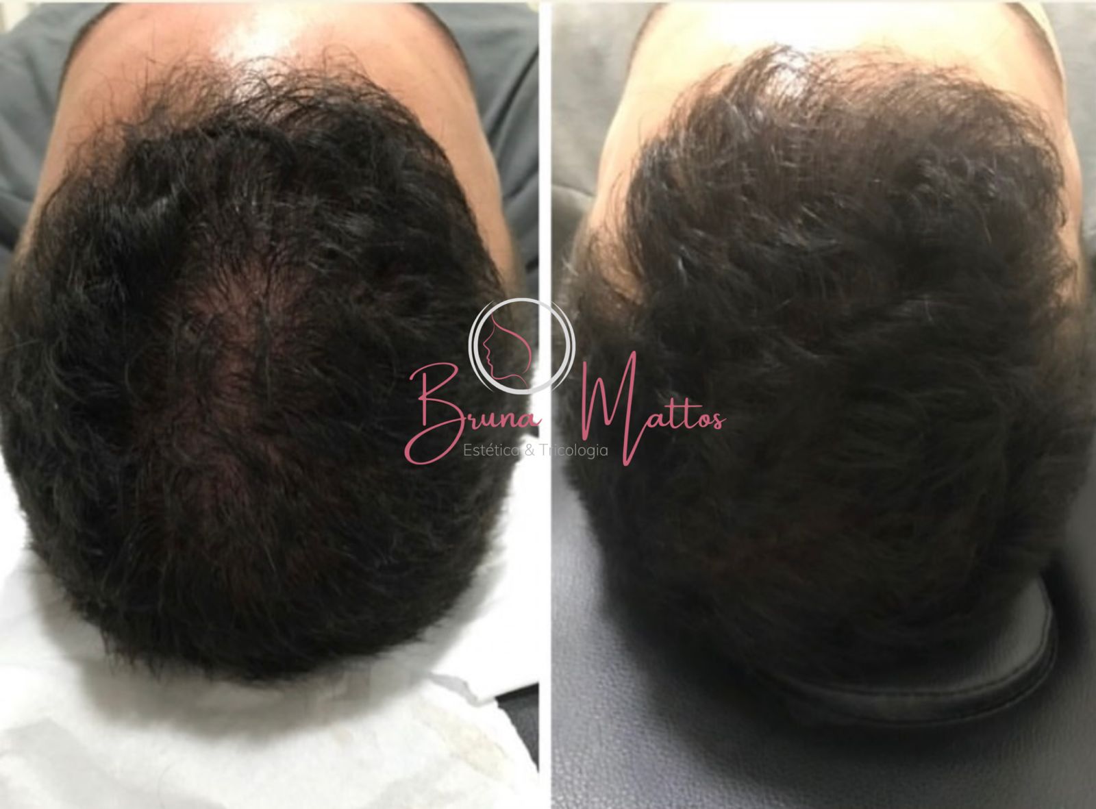 Antes e depois do tratamento capilar — paciente 3